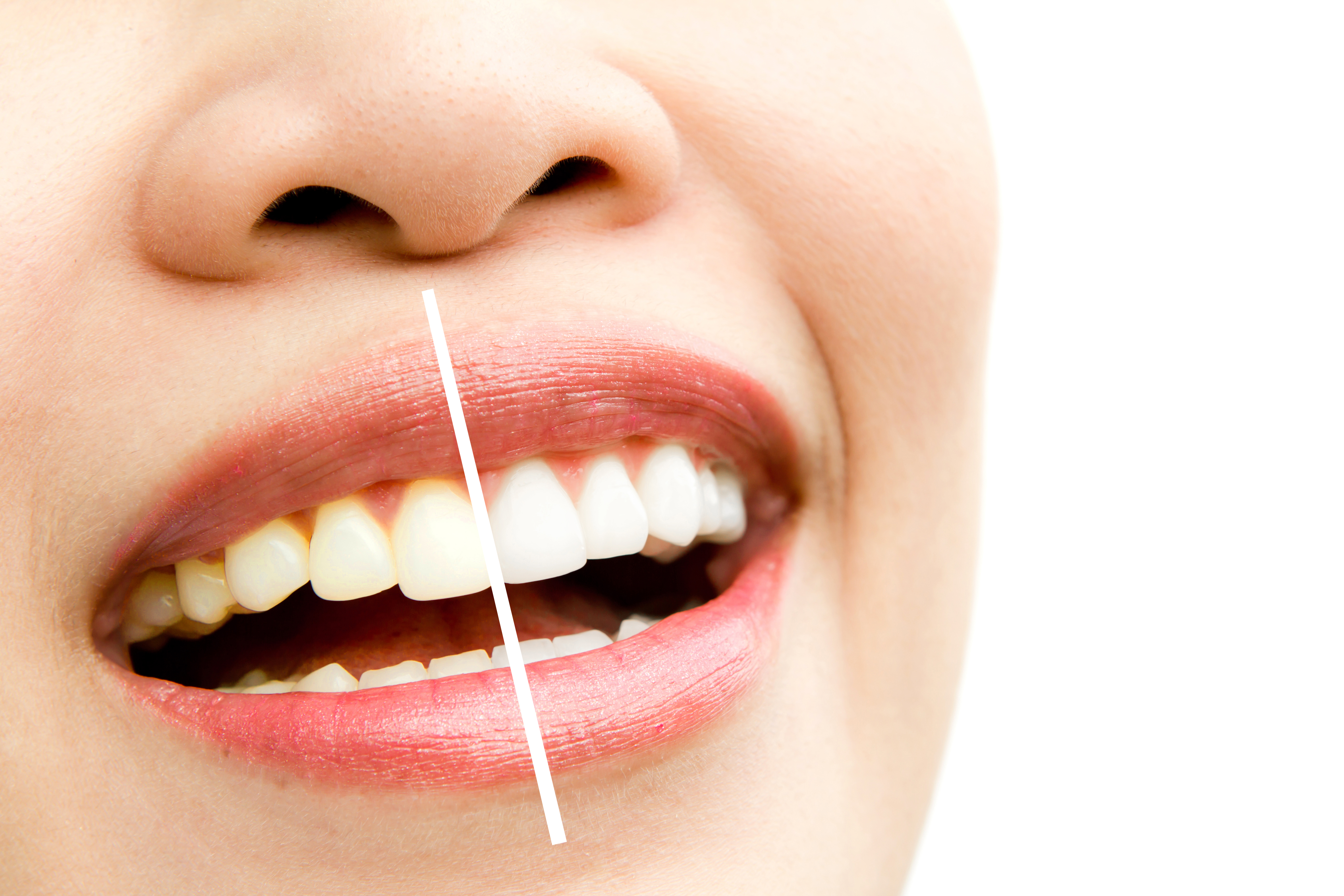 Professional teeth whitening